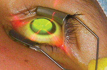 Korneales Crosslinking